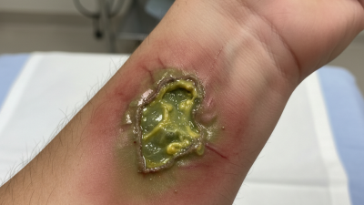 Top Signs of Poor Wound Healing You Should Not Ignore?