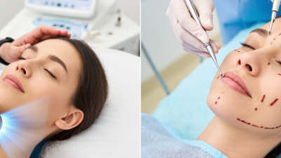 Why Is HIFU Better Than a Traditional Facelift?