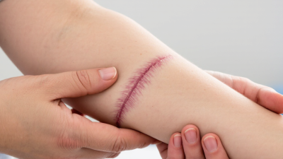 Why Are Best Practices for Scar Tissue Massage Important?