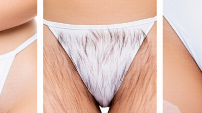 Top 10 Reasons Why Hair Grows Back Uneven After Laser?