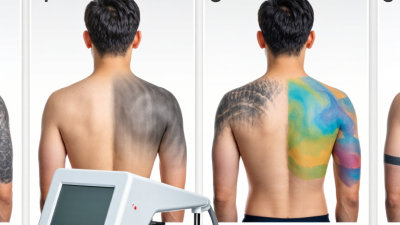 How Many Sessions for Full Tattoo Removal?