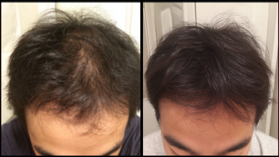 Exploring Natural Alternatives for the Best Hair Loss Dietary Supplement