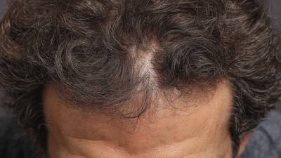 Unlocking the Power of Folic Acid: A Scientific Approach to Boosting Hair Growth Naturally