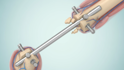 2026 How Interlocking Nail Implant Works and Its Benefits?