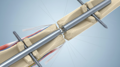 How to Use Interlocking Nail Implant for Bone Fracture Repair?
