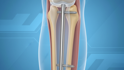 What is Tibial Interlocking Nail and How Does It Work?