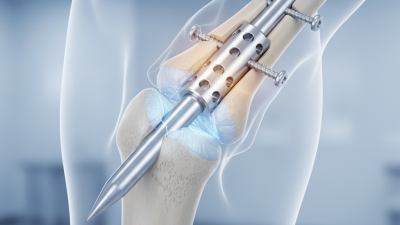 Top 10 Benefits of Feumr Interlocking Nails for Bone Healing?
