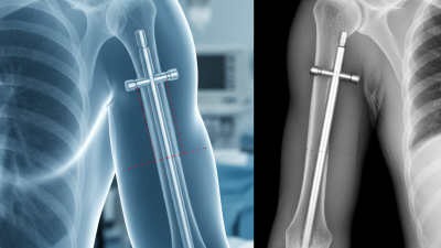 What is Humeral Interlocking Nail and How is it Used?