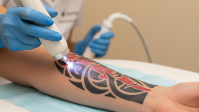 What is Yag Tattoo Removal Laser and How Does it Work?