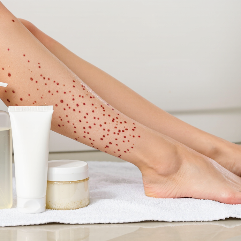 How to Get Rid of Strawberry Legs Overnight?