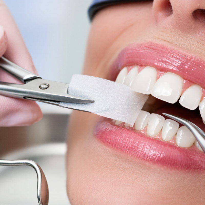 What Is Dental Teflon Tape Used For?