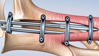 What Is a Tibia Intramedullary Nail?