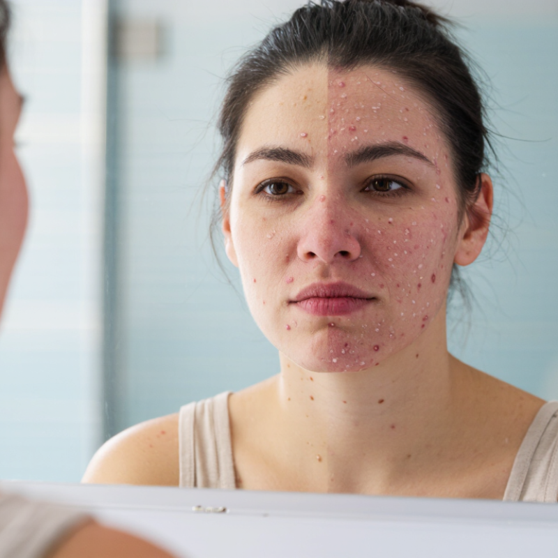 Why Is My Skin Purging or Breaking Out?