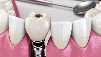 7 Tips for Choosing Screw Retained Restorations?