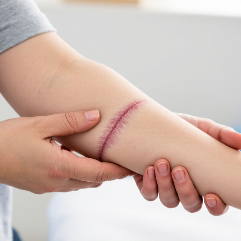 Why Are Best Practices for Scar Tissue Massage Important?