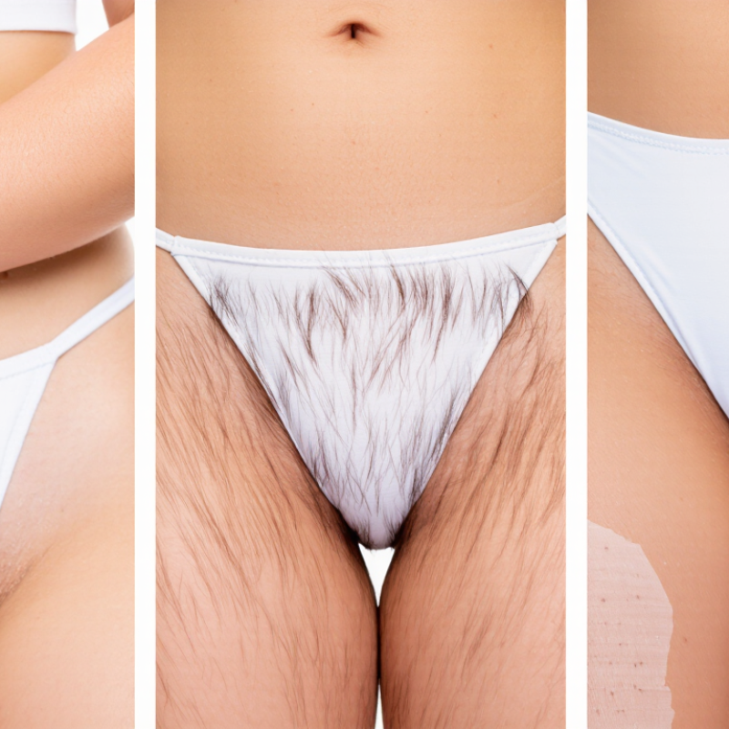 Top 10 Reasons Why Hair Grows Back Uneven After Laser?