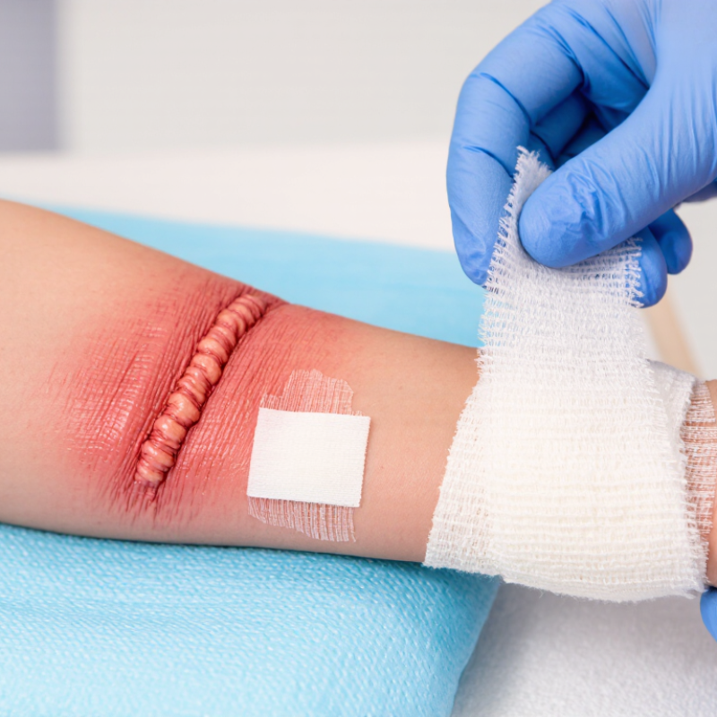 2026 Best Ways to Prevent Hypertrophic Scars