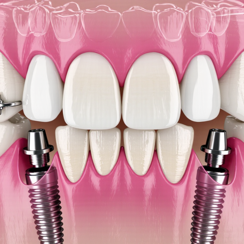 What Is a Dental Prosthesis and What Types Are Available?