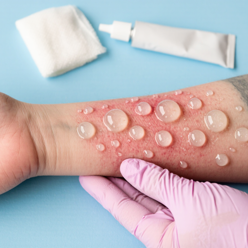 How to Heal Blisters After Tattoo Removal Safely
