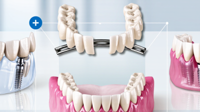 What Are the Top China Dental Bridge Restorations?