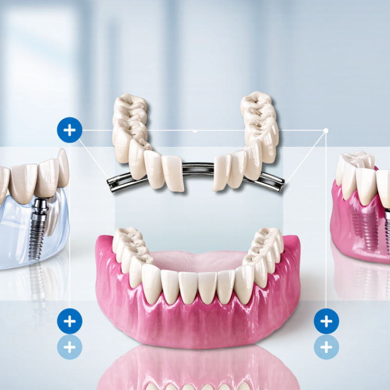 What Are the Top China Dental Bridge Restorations?