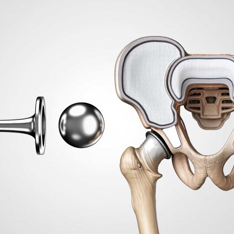 What Is a Hip Replacement System and How to Choose It?
